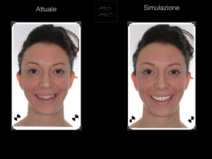 simulazione-sorriso-dentale-digitale-01