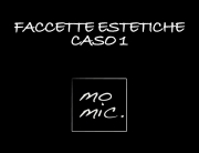 faccette_estetiche_caso_1